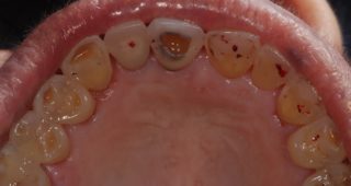 ricostruzione-smalto-denti-erosione-studio-dentisticomarina-anselmi