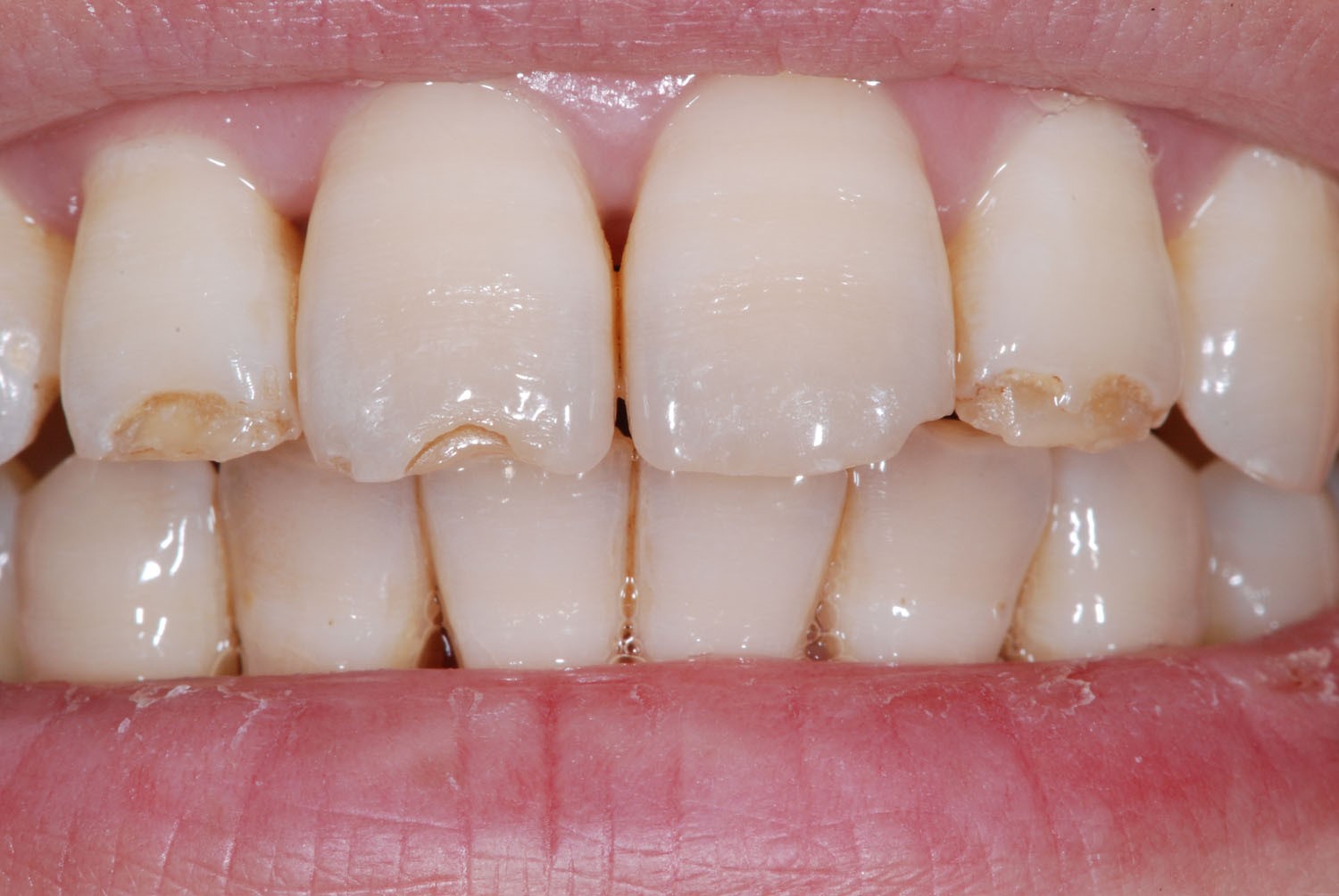 Ricostruzione smalto: la soluzione per denti consumati, accorciati,  scheggiati. - Studio Dentistico Drssa Marina Anselmi