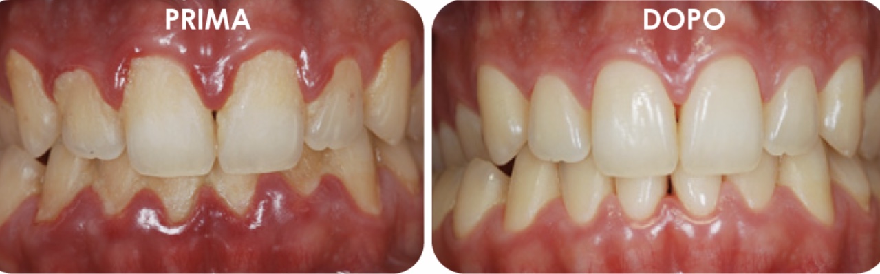 Ricostruzione smalto: la soluzione per denti consumati, accorciati,  scheggiati. - Studio Dentistico Drssa Marina Anselmi